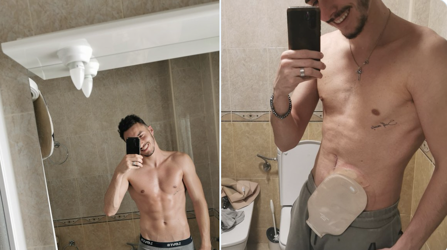 David Rosano, mostrando la %22bolsa%22 tras su ostomía.