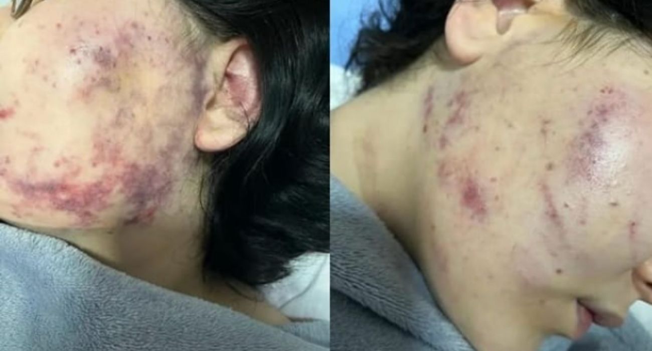 Las heridas en la cara sufridas por la joven tras la brutal agresión. 