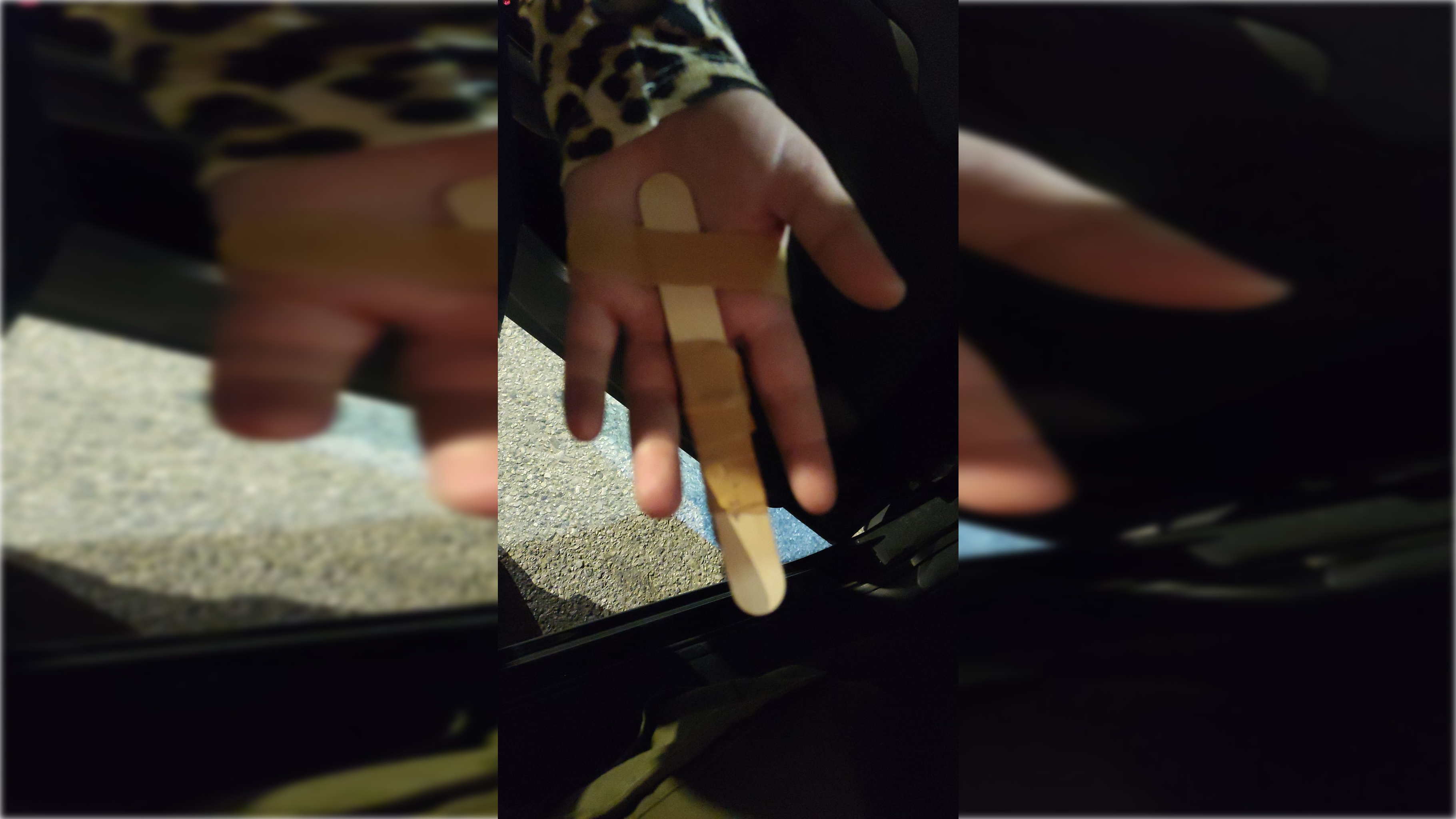 Denuncian "una chapuza" en el Hospital de Sanlúcar: se rompe un dedo le ponen un depresor de lengua 