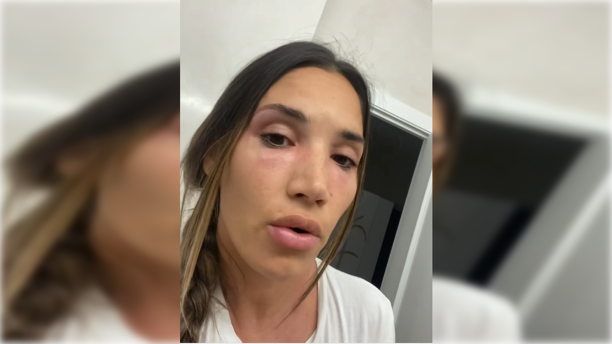 India Martínez muestra sus erupciones cutáneas.   INSTAGRAM 16x9