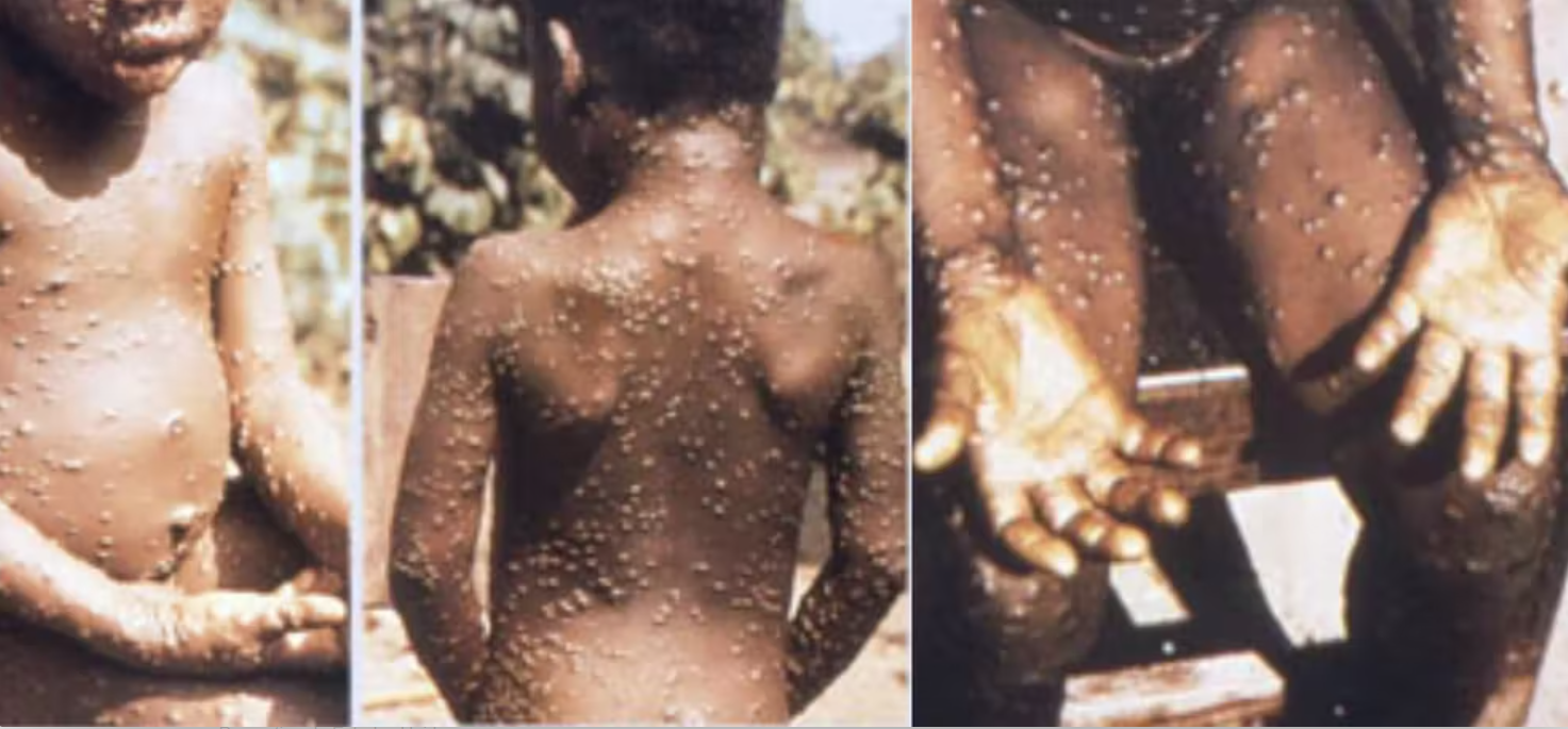 Viruela del mono, caso extremo. THE CONVERSATION Viruela del mono, caso extremo. THE CONVERSATION