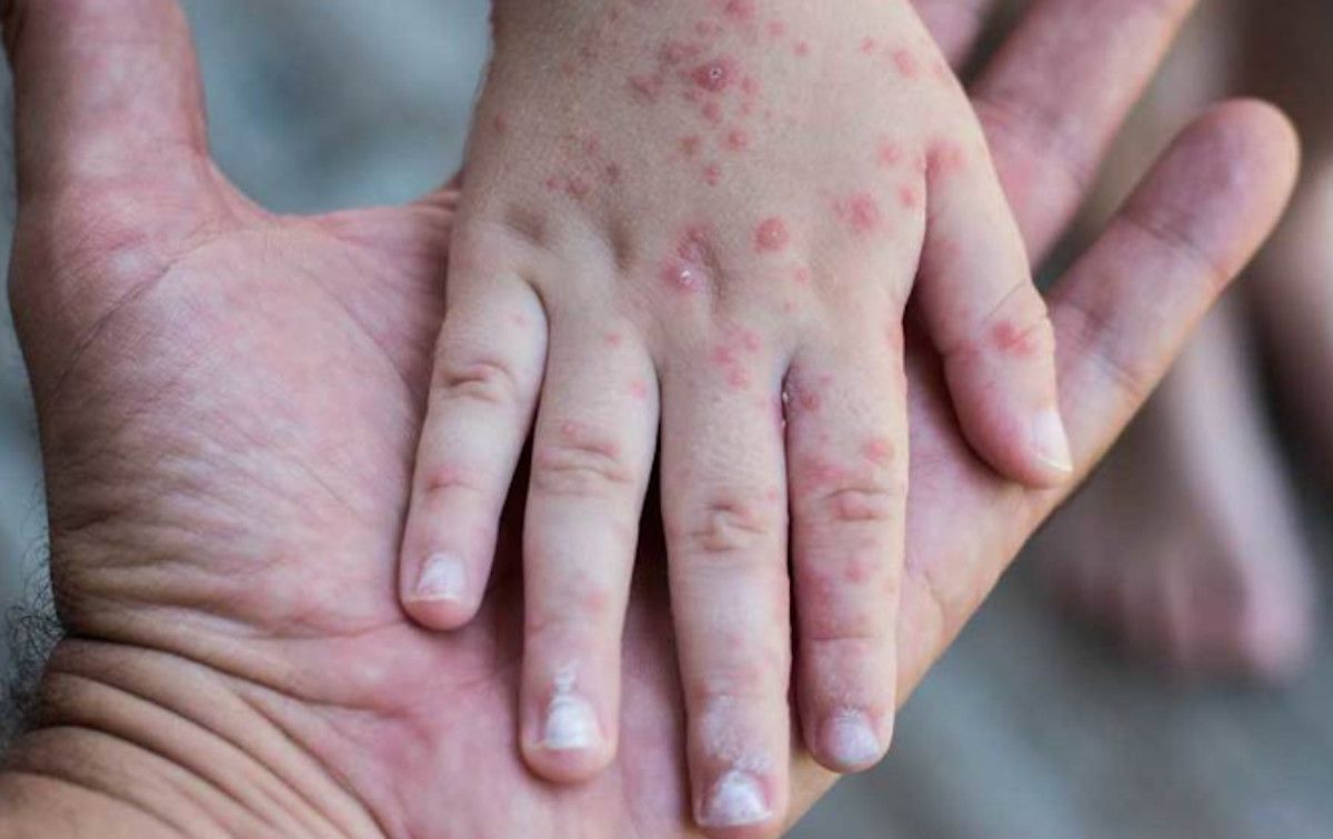 La surrealista historia de cómo se contagio de viruela del mono: "No he participado en ninguna fiesta sexual" La surrealista historia de cómo se contagio de viruela del mono: "No he participado en ninguna fiesta sexual"