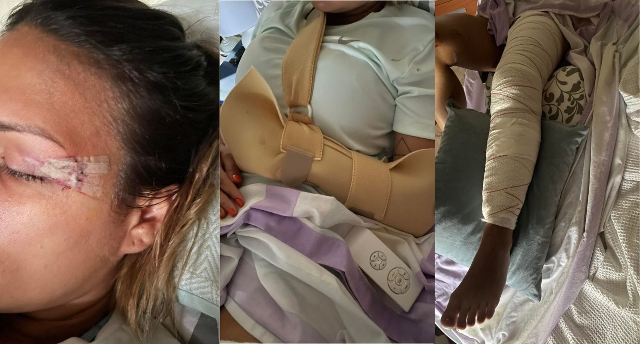 Las heridas sufridas por la joven que ha sido arrollada por una furgoneta azul en Cádiz.