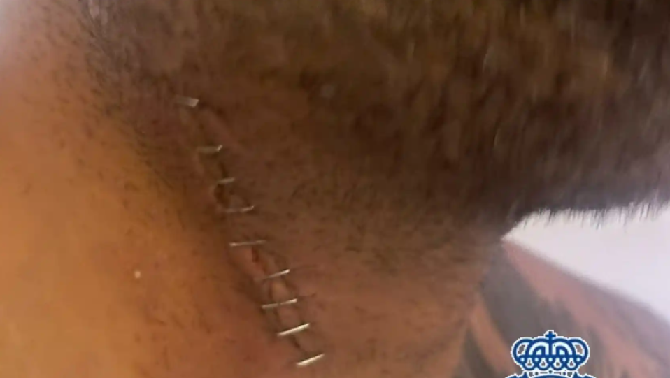 Herida de la víctima.  Policía Nacional "Un 'influencer' sueco propina una puñalada en la garganta a un hombre en Estepona"