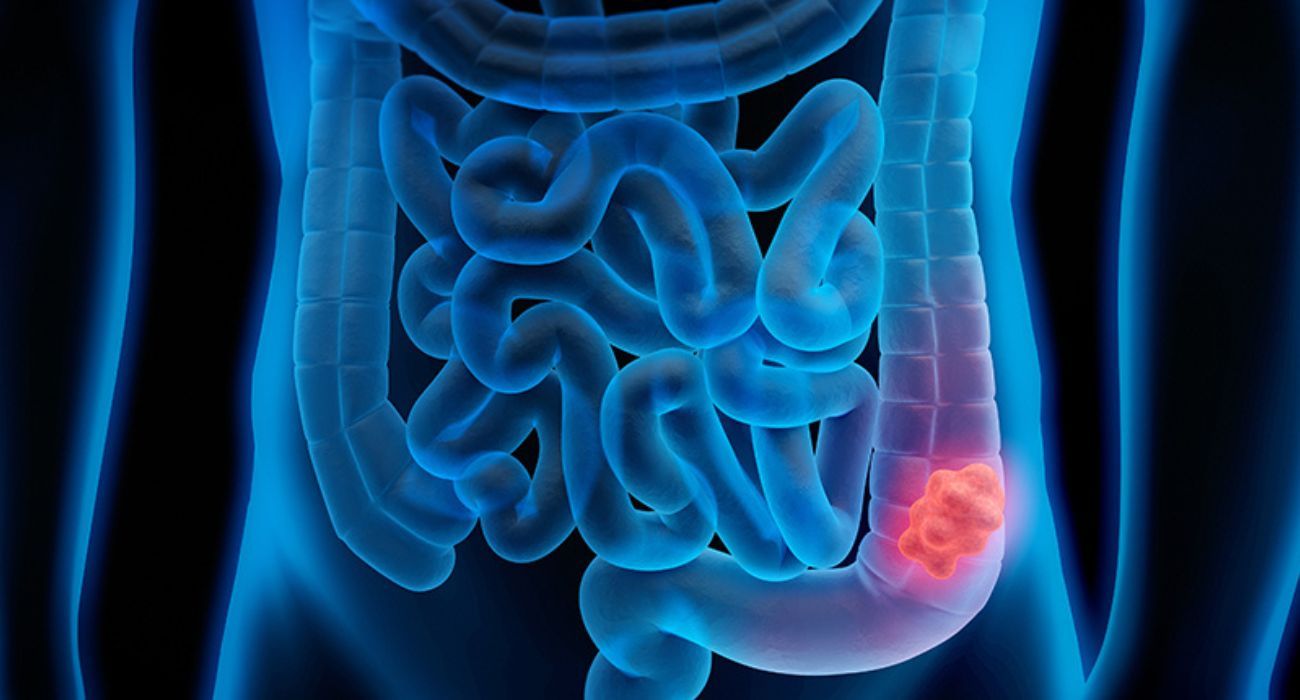 Una de las pruebas médicas para detectar el cáncer de colon.
