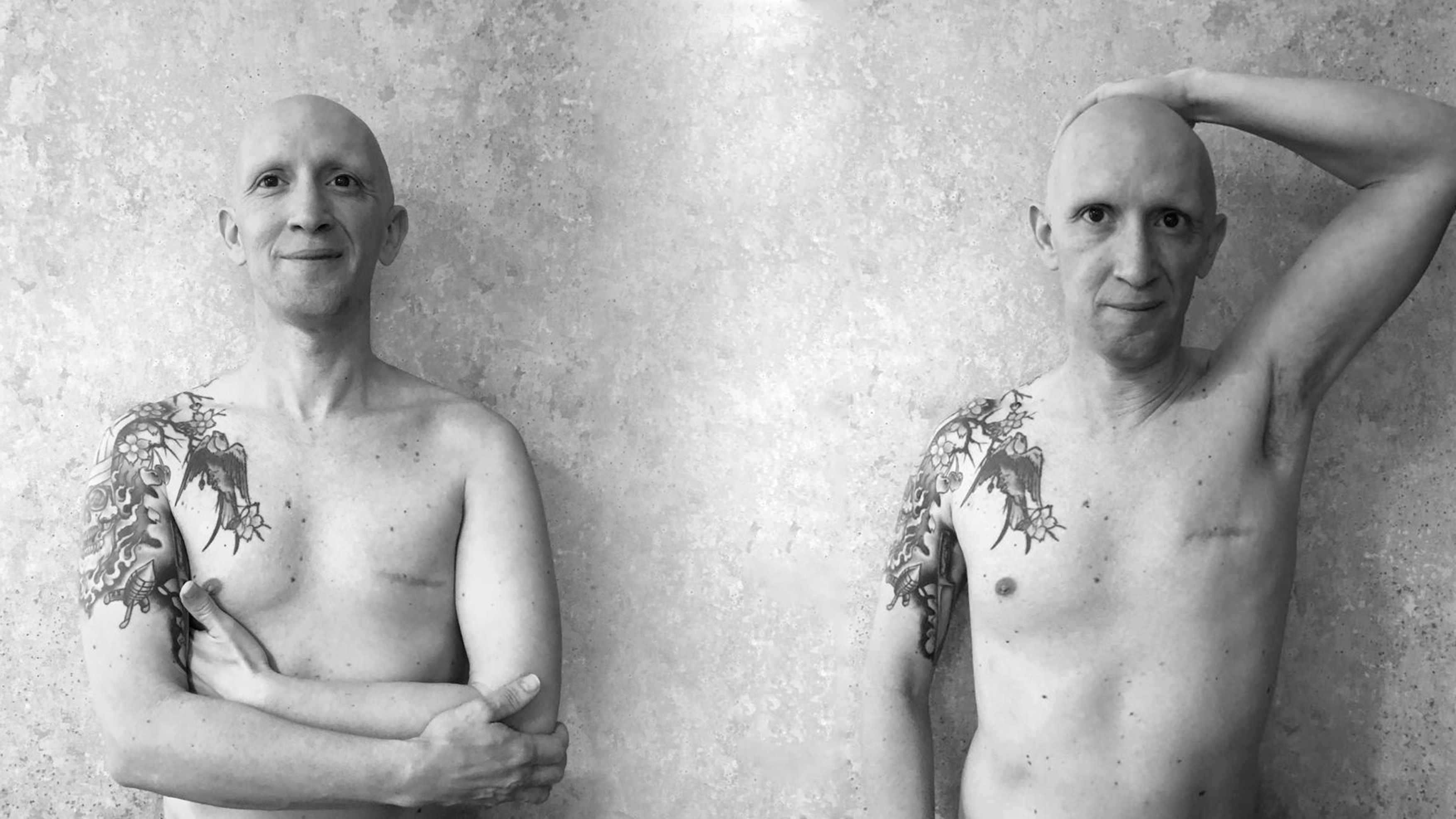 Juande Trujillo padece cáncer de mama masculino.