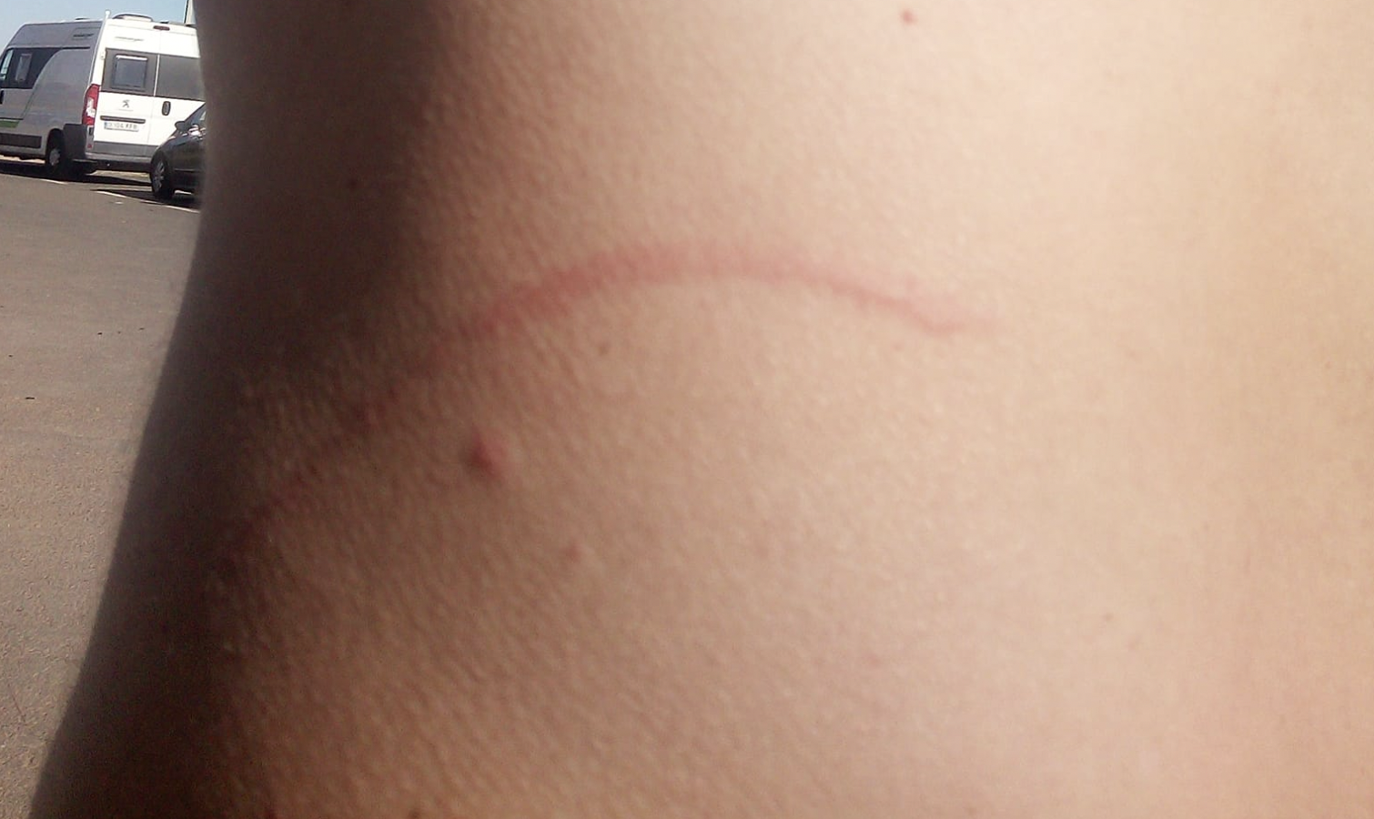 Arañazos en el torso del vecino de Conil que ha sufrido el ataque de un perro en la playa.