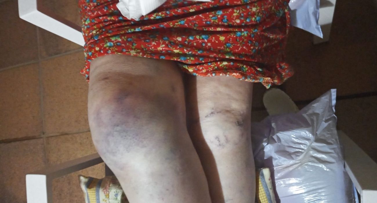Estado de las rodillas de la mujer accidentada tras sufrir una caída por culpa del acerado de la avenida Lola Flores en Jerez. 