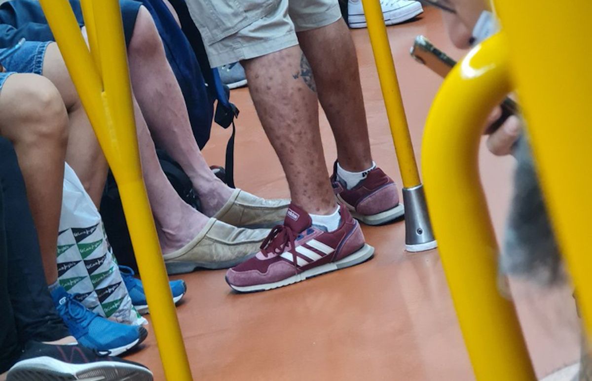 Un hombre con viruela del mono viajando en metro.