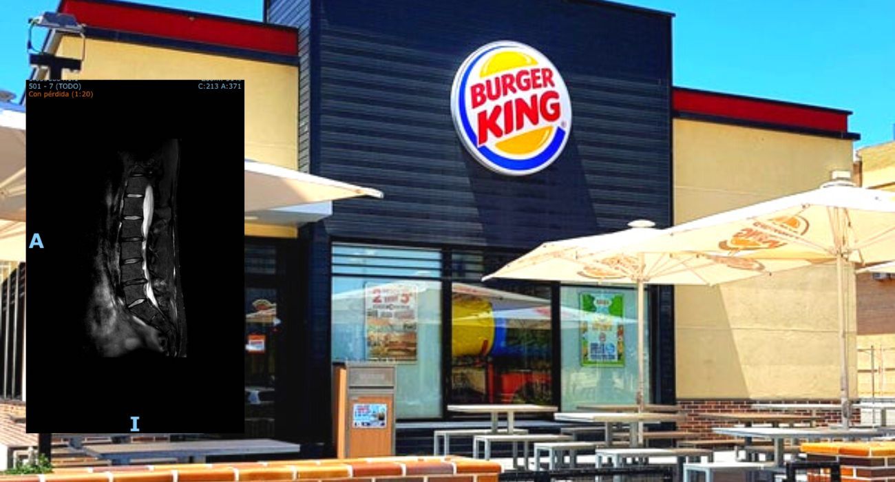 La imagen de la resonancia de una joven que ha denunciado ser despedida por Burger King tras sufrir un accidente laboral.