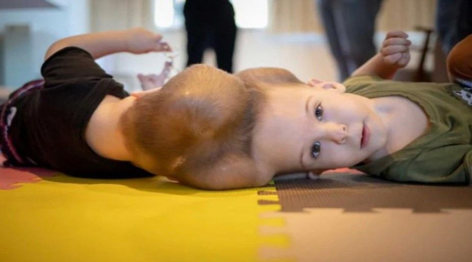Siameses brasileños unidos por la cabeza han sido separados con éxito.Instituto Estatal del cerebro Paulo Niemeyer