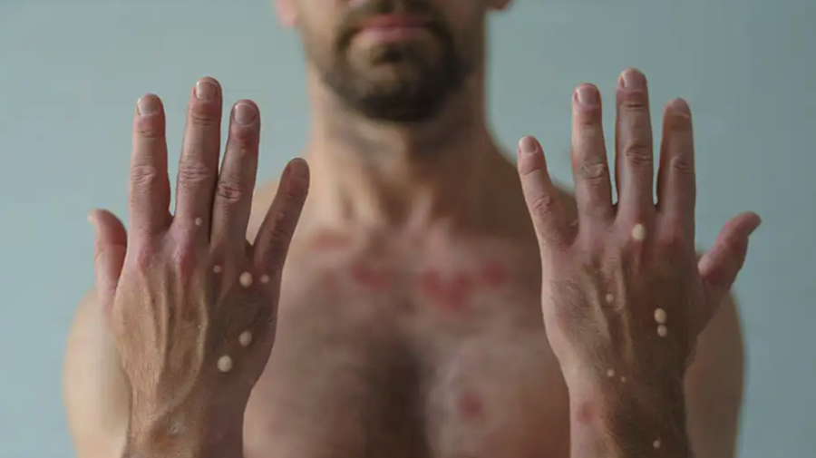 Imagen de archivo de un hombre afectado por la viruela del mono.