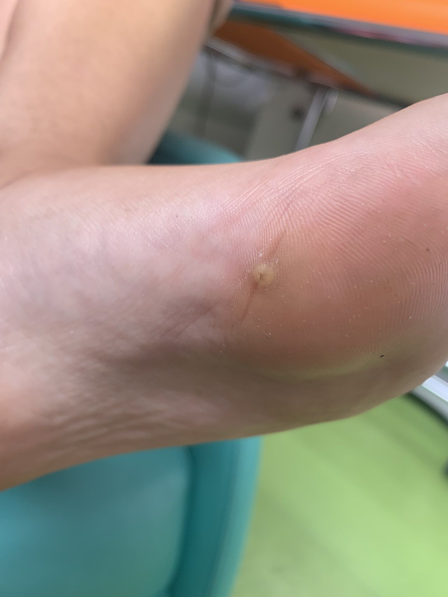 Pie del joven que acudió a Urgencias. Un médico arrasa en Twitter con el extraño caso que tuvo que atender: "Nuevo miedo desbloqueado"