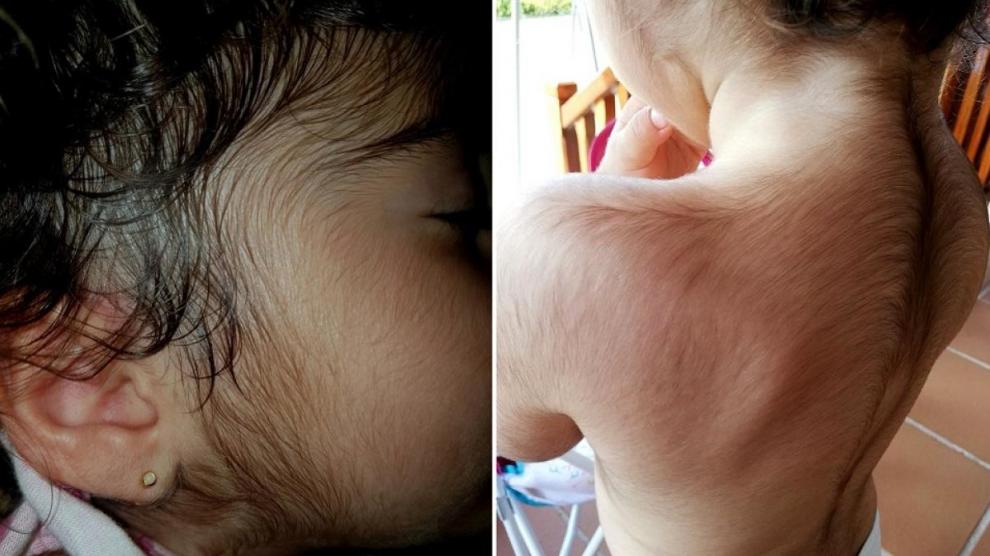 La niña de la familia cántabra que padece 'Síndrome del Hombre Lobo', Sigue abierta la causa a la farmacéutica malagueña que suministró crecepelo en el omeprazol para bebés