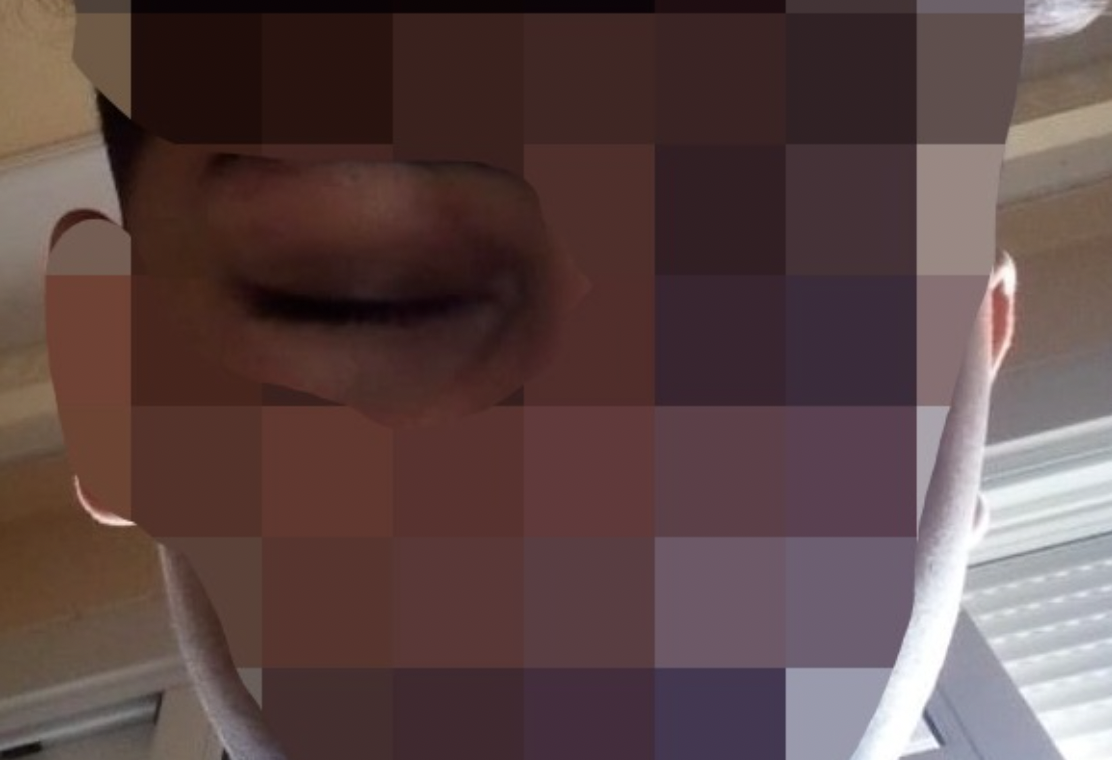 Violencia en las aulas de Melilla, tres agresiones en un mes: "El niño no puede abrir el ojo".