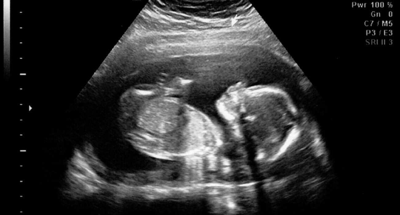 Ecografía de un bebé. El vicepresidente de Castilla y León ha propuesto que las mujeres que estén embarazadas tengan que escuchar los latidos del embrión o del feto.