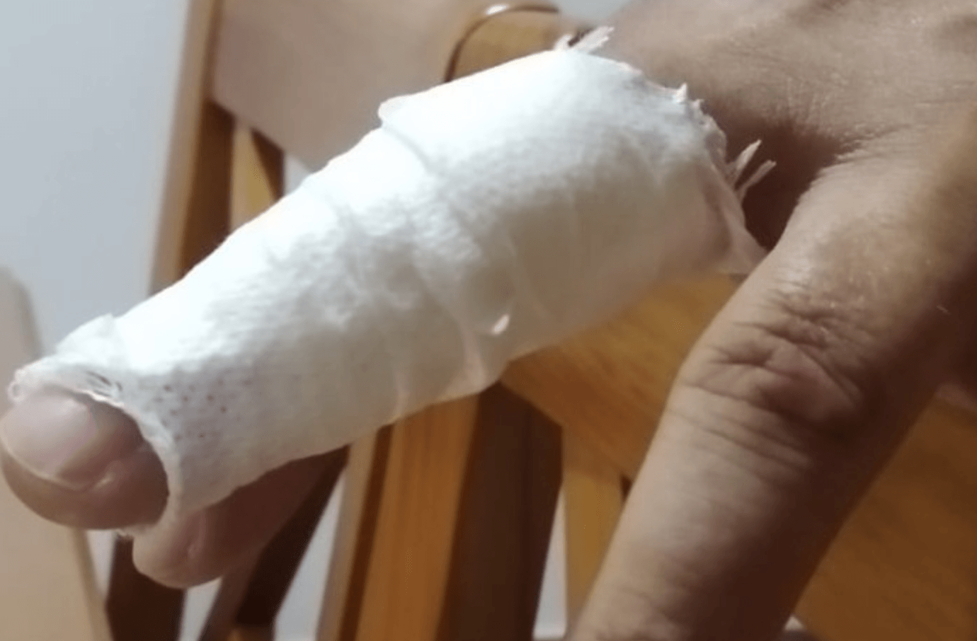 Lesiones en el dedo de una mano de uno de los funcionarios heridos.