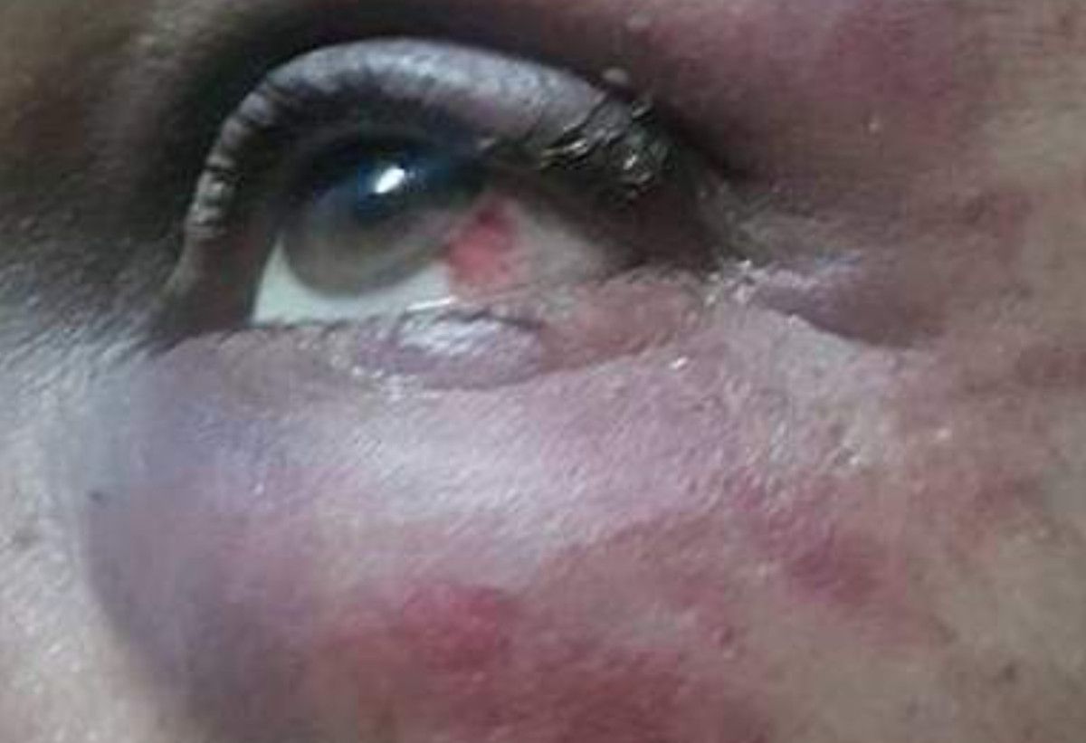 El ojo dañado de Laura, una joven que denuncia ser víctima de una agresión tránsfoba en Barcelona. 