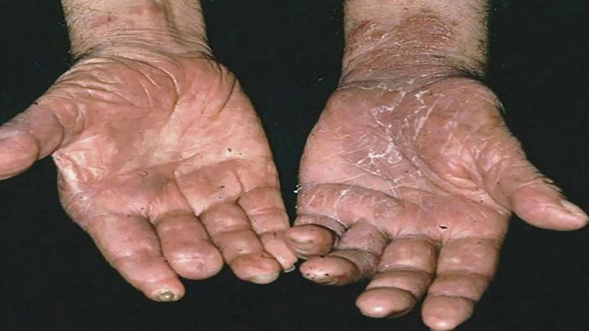 Unas manos afectadas por la lepra.