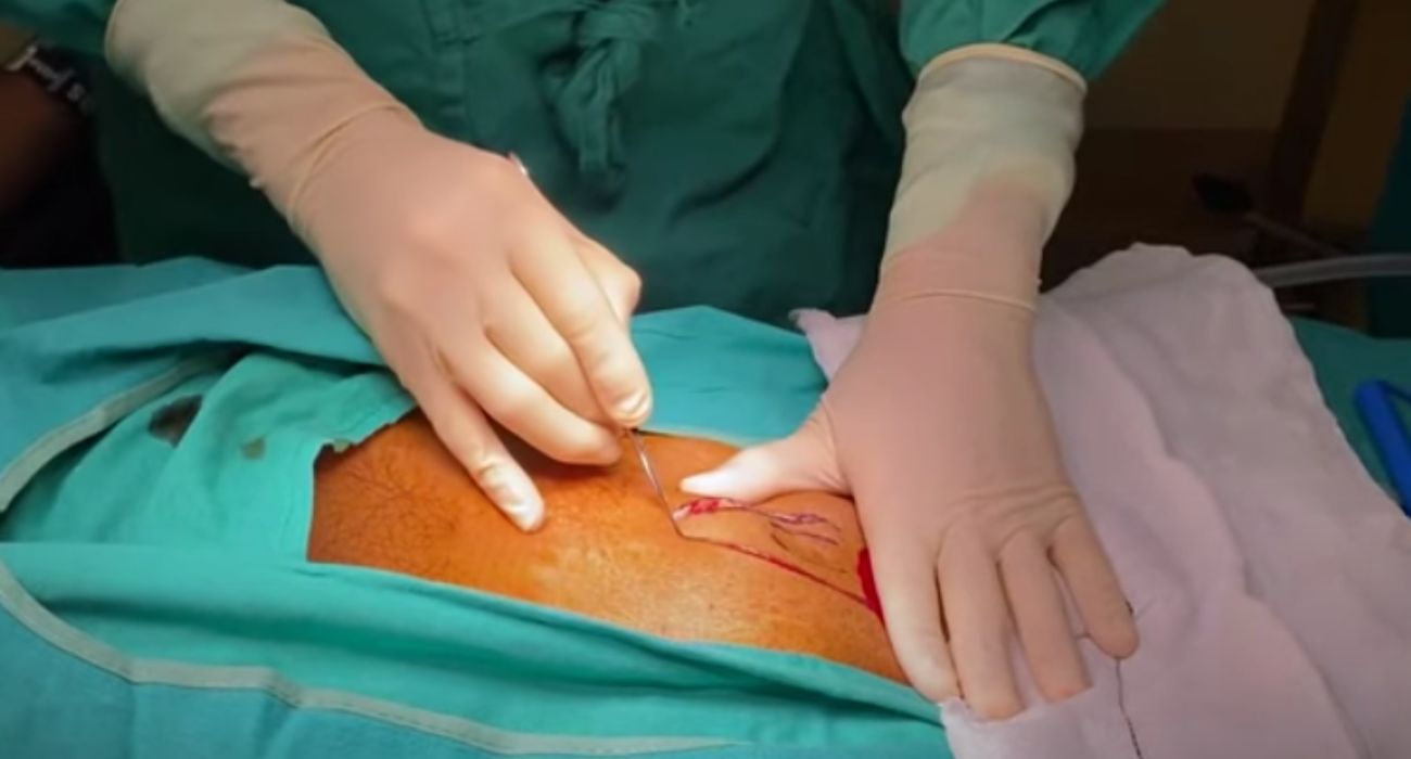 Una intervención quirúrgica relacionada con el órgano genital masculino.