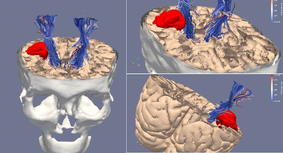 Modelo en 3D del cráneo, el cerebro y el glioma de un paciente.