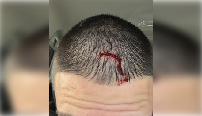 La herida que sufrió el jugador del CD El Torno 2009 tras el encontronazo con el futbolista del Afición Xerez CD.