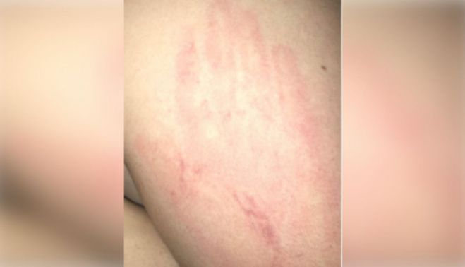 Otra de las agresiones sufridas por la joven.