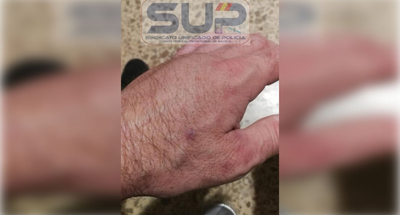 La mano del agente de la Policía Nacional que resultó herido.