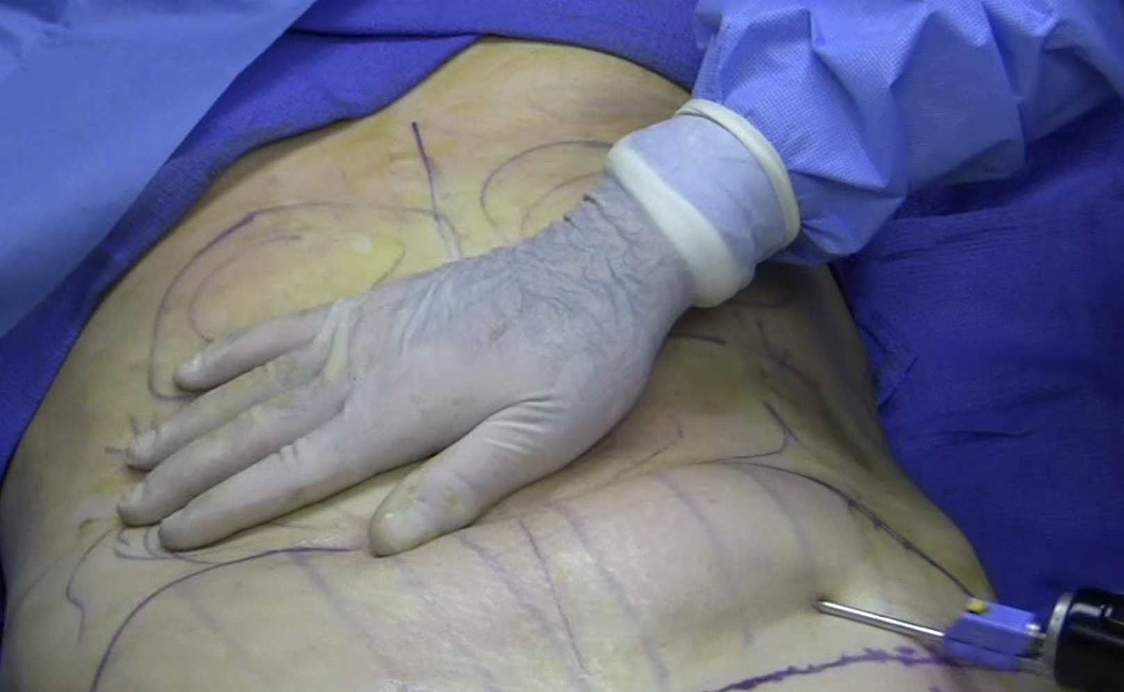 Liposucción, en una imagen de Michael S. Schwartz, M.D. en Wikimedia.