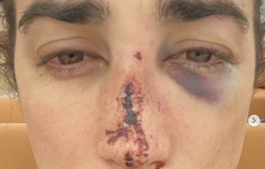 Divino tras la agresión, con la nariz y el pómulo rotos.