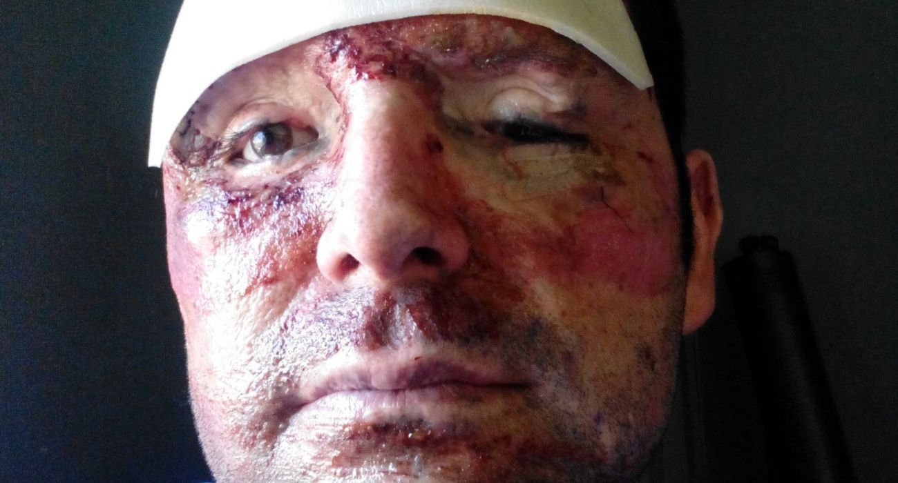 Pepe Candón, con las heridas sufridas en la trágica explosión de febrero de 2011.