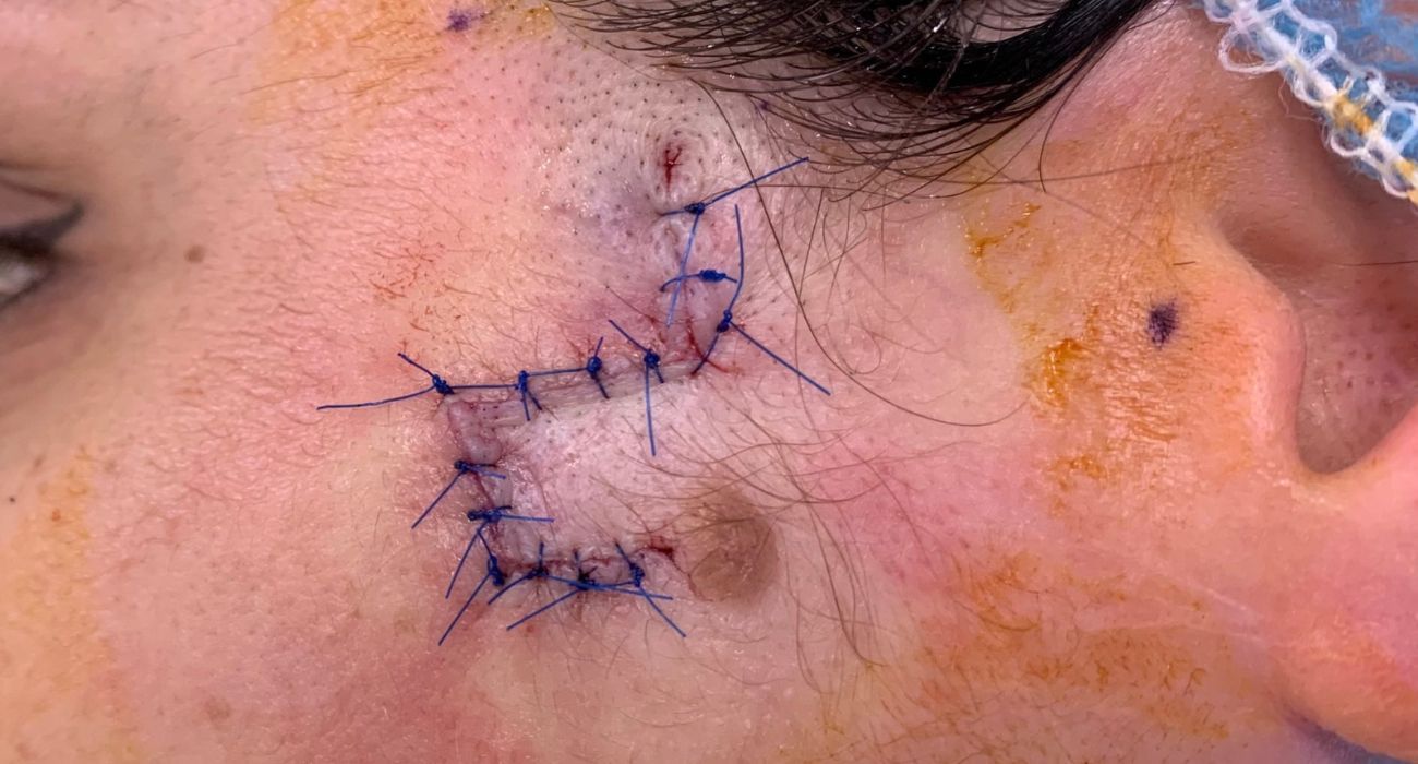 Las secuelas de la intervención tras el cáncer de piel sufrido por Sara Díaz.