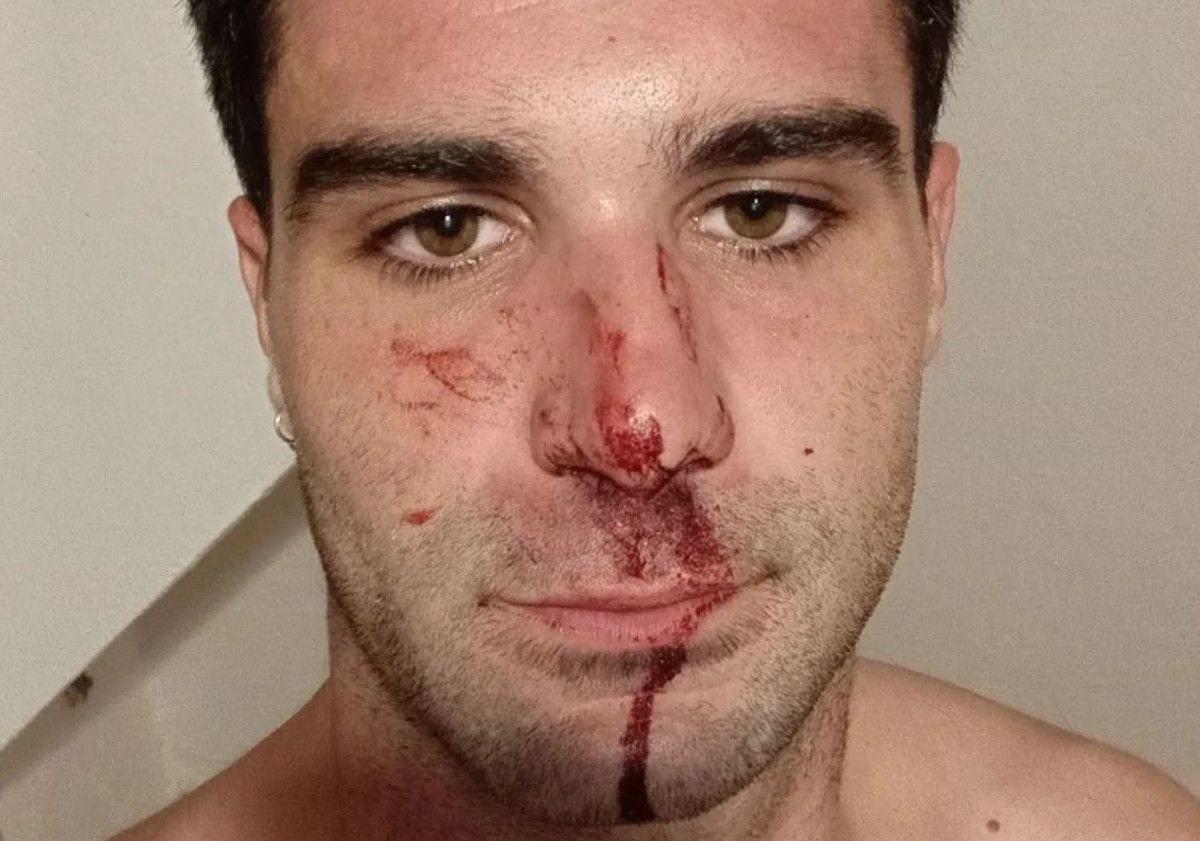 Agustín ha sufrido una agresión homófoba en Córdoba.  INSTAGRAM