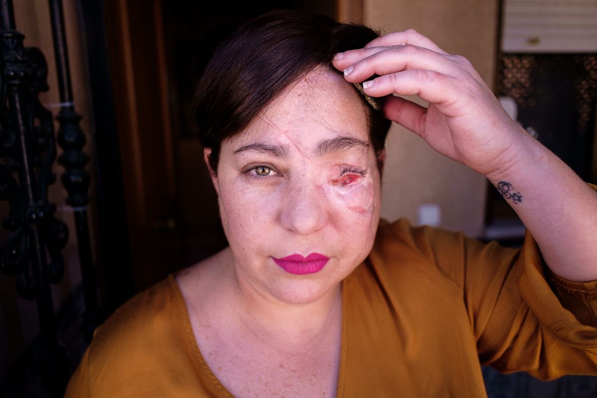 Rocío Vázquez muestra las secuelas de la pérdida de un ojo, porque insiste en que quiere hacer reconocer su calvario. FOTO: MANU GARCÍA