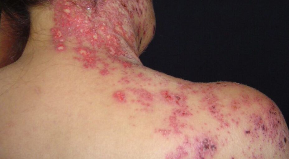 Una persona con herpes localizado en la zona del cuello y espalda. 