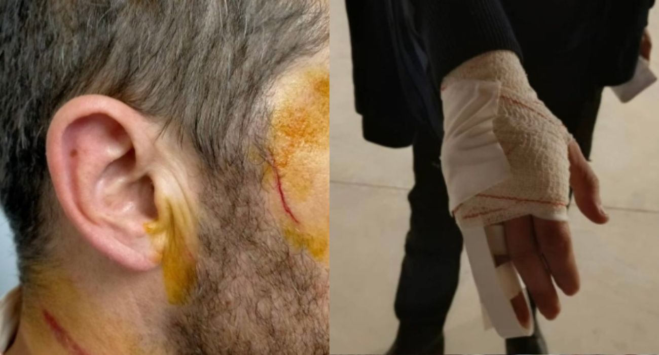 Las heridas sufridas por el funcionario de prisiones atacado por un preso.