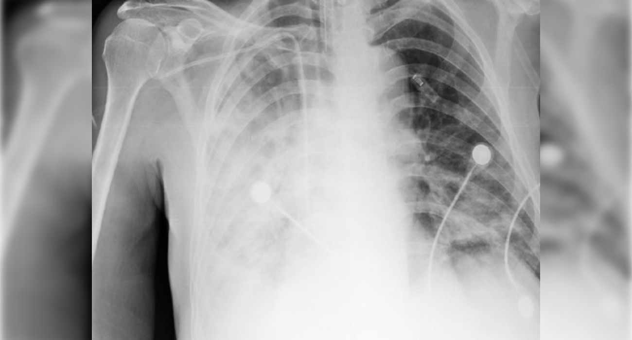 Los pulmones de un paciente afectado por melioidosis, una batería mortal que infecta el agua.