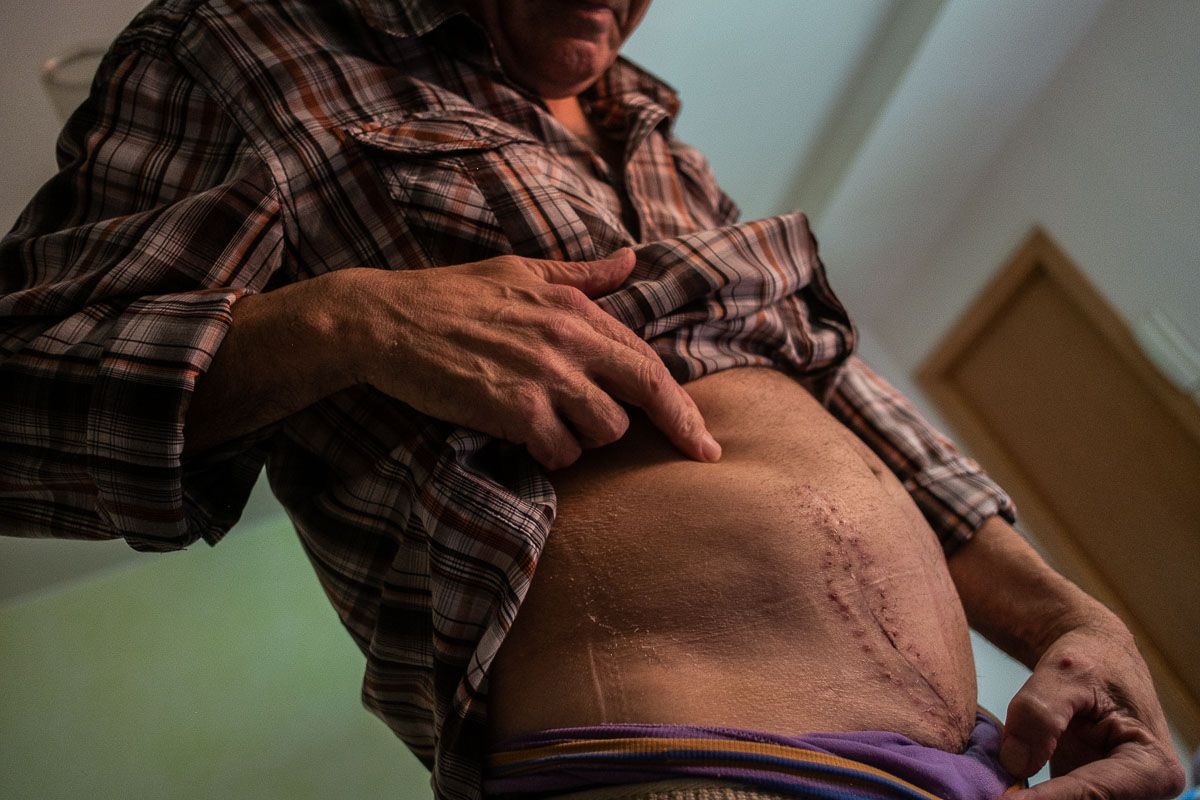 Antonio, mostrando la cicatriz fruto el trasplante de riñón al que se ha sometido. FOTO: MANU GARCÍA