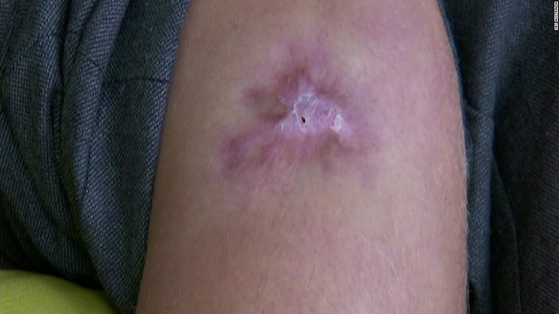Una úlcera de Buruli detectada en el brazo de un hombre. 