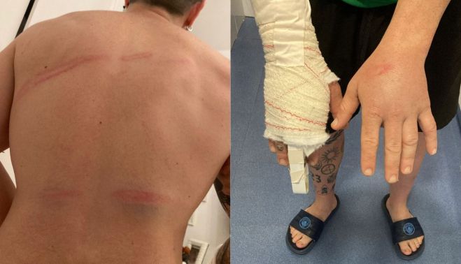 Golpes y contusiones.