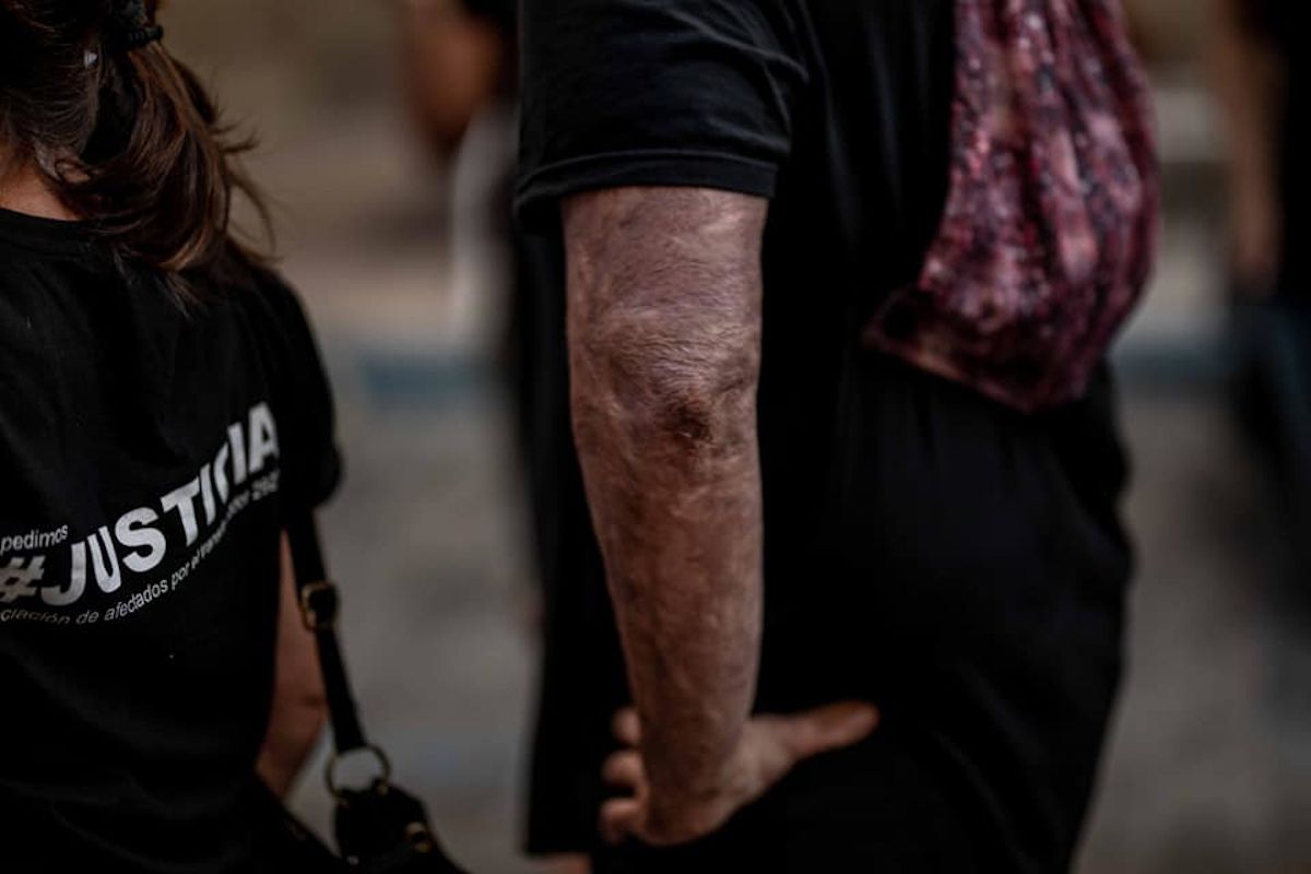 Quemaduras en el brazo de uno de los supervivientes del incendio.