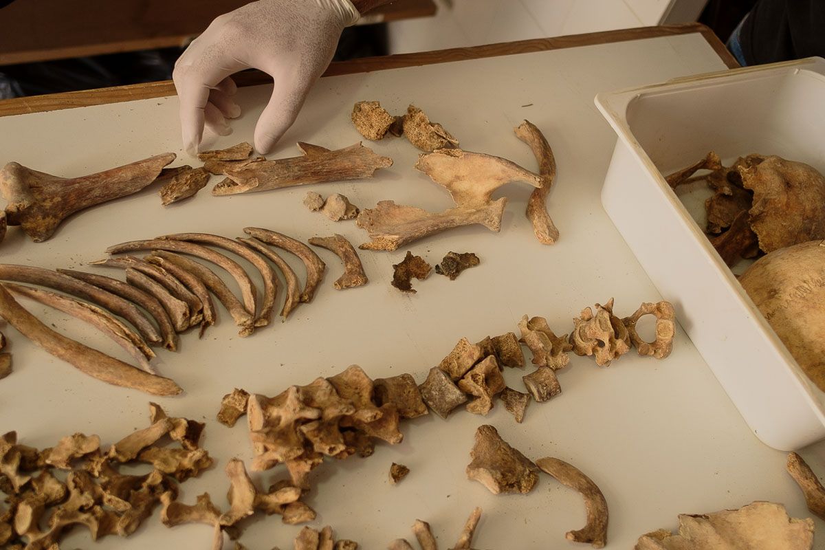 Javier señala un hueso fracturado por el impacto de un proyectil. FOTO: MANU GARCÍA