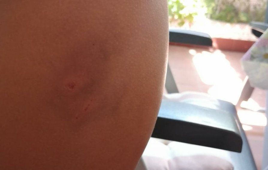 Una de las contusiones y heridas de la víctima. FOTO: ABRIR BRECHA JEREZ