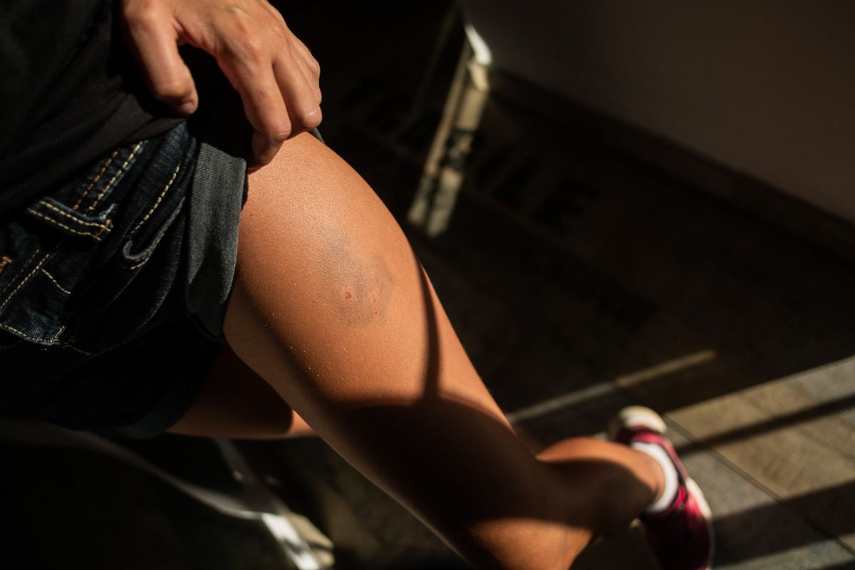 Contusiones por la agresión machista en Jerez. FOTO: MANU GARCÍA