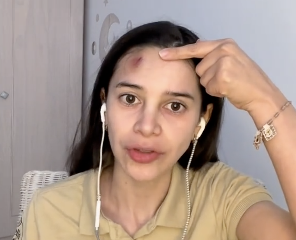 La camarera muestra la herida sufrida tras ser golpeada por su jefe en la cabeza.