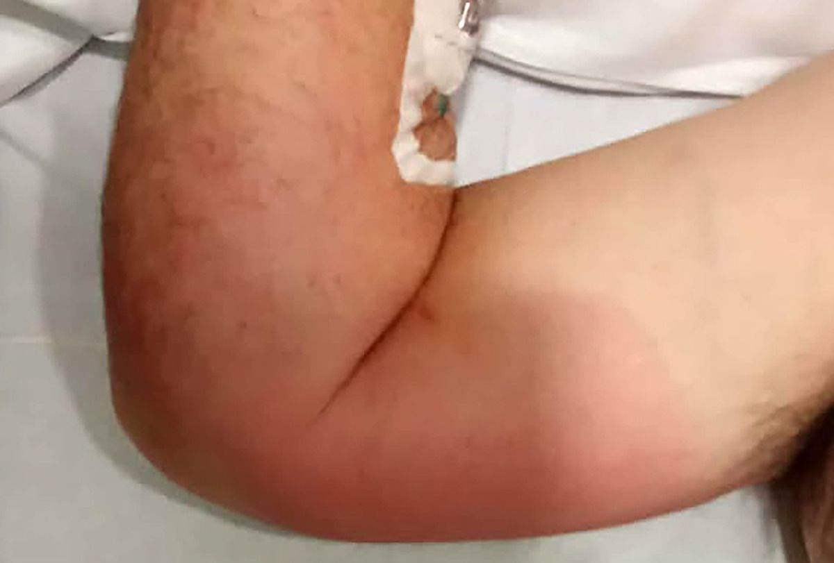 Inflamación sufrida por Manuel.