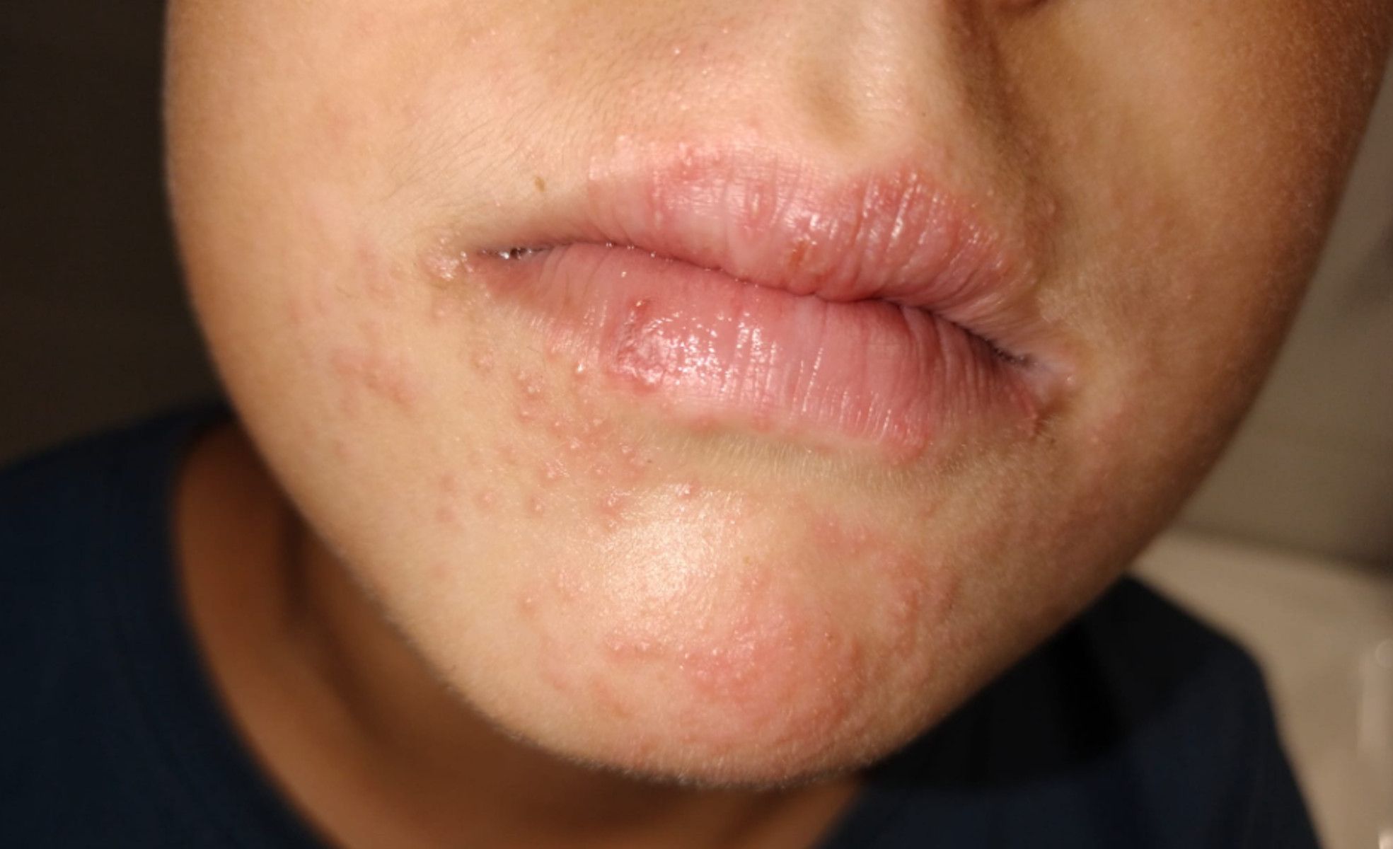 Reacción provocada por la comida servida en el CEIL La Motilla de Dos Hermanas.