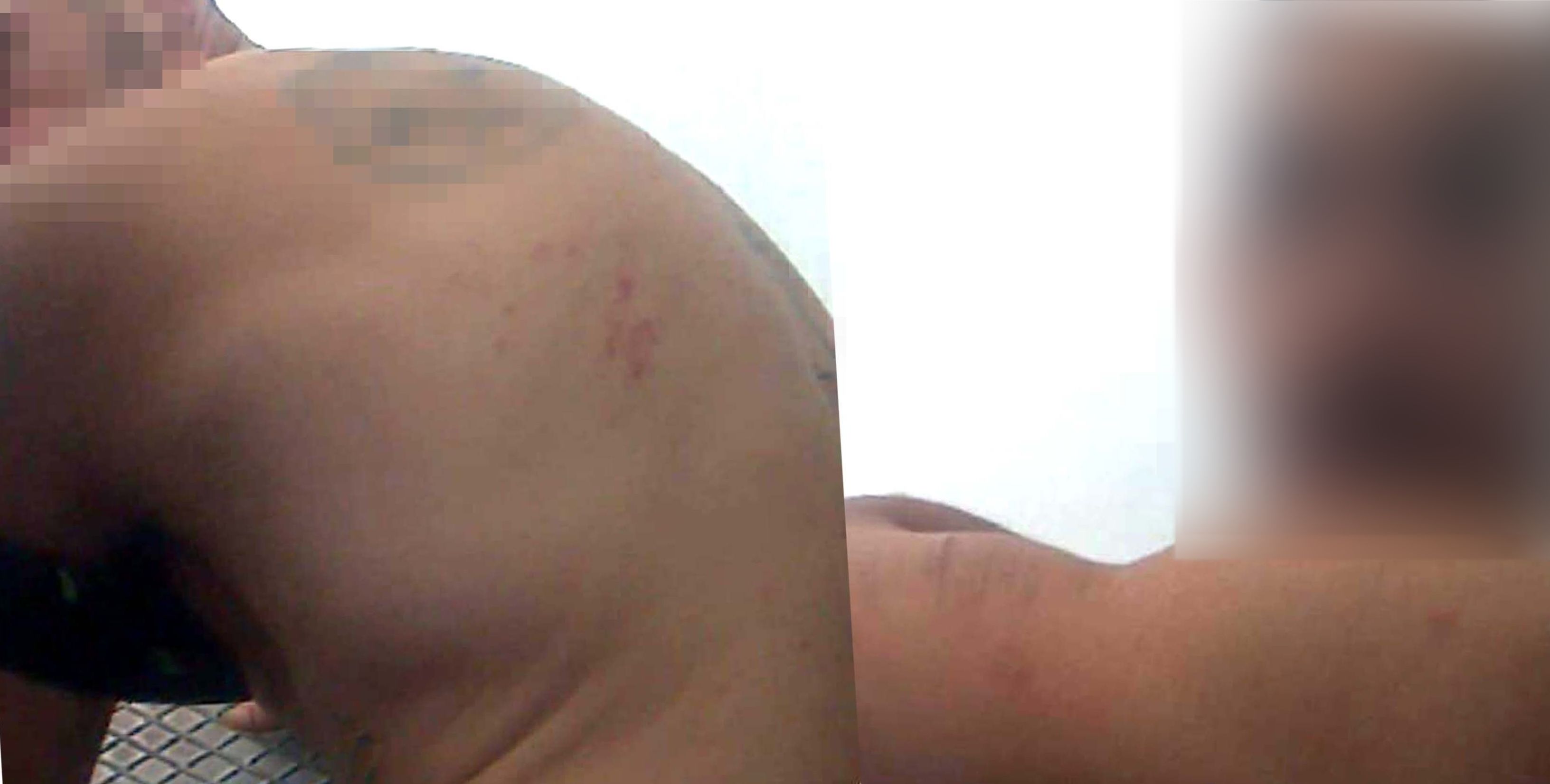 Un preso de Botafuegos, con picaduras de chinches.