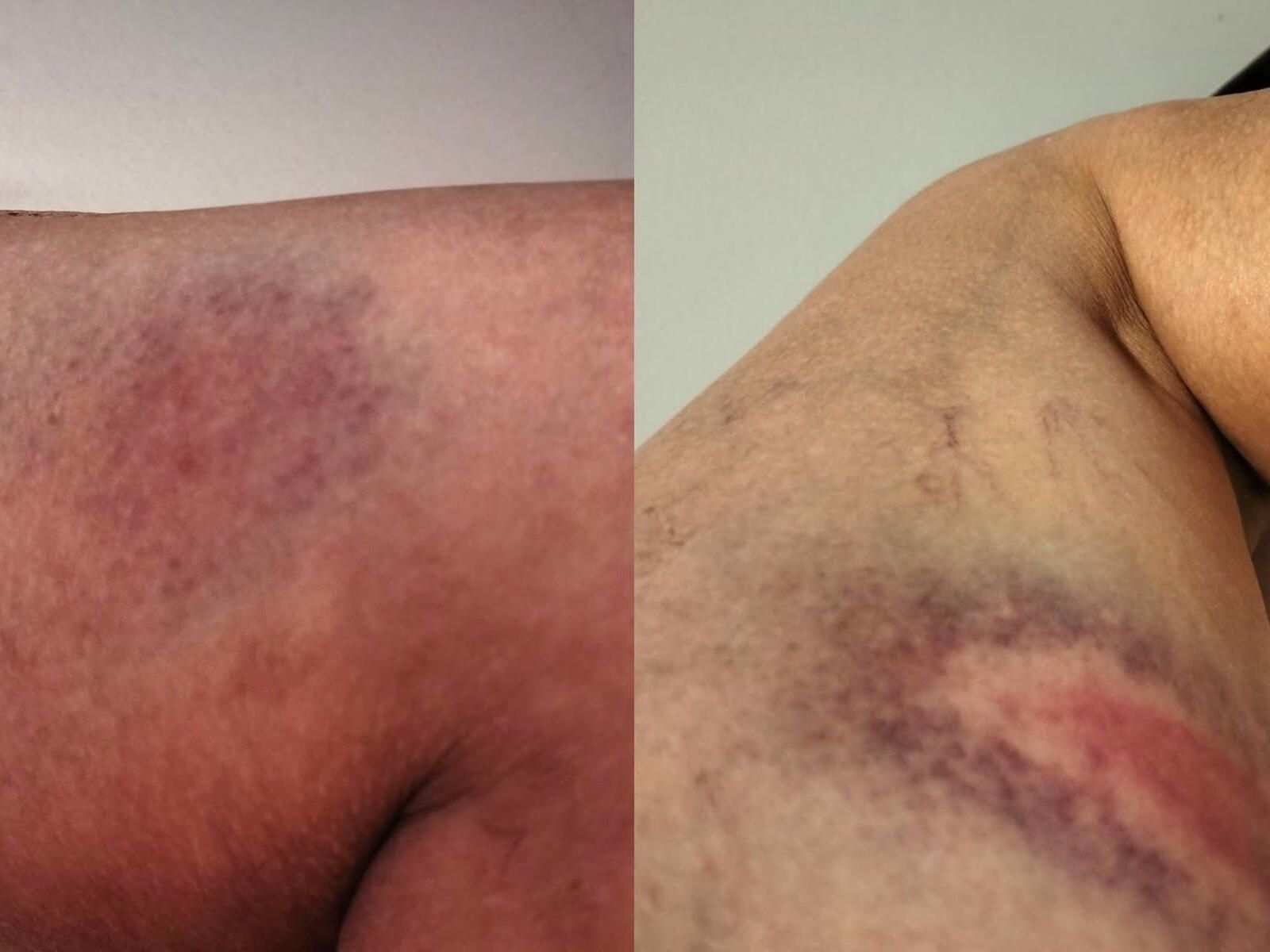 Hematomas de manifestantes.