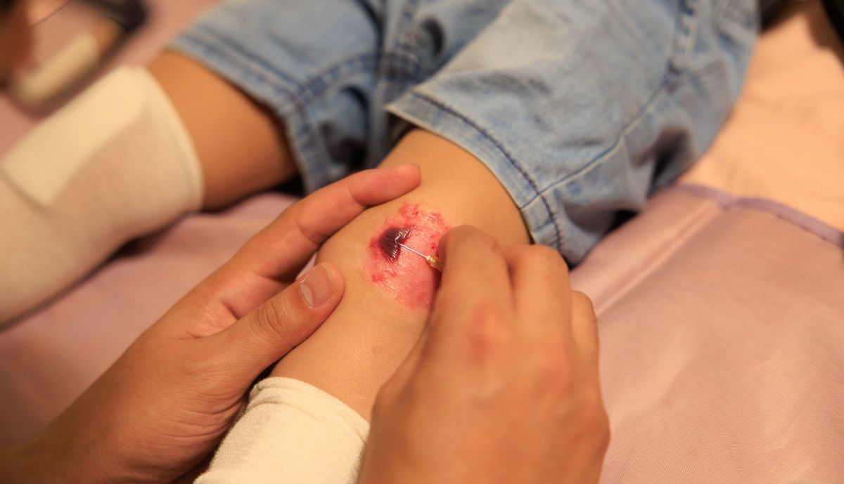 A Mateo le aparecen heridas por todo su cuerpo.